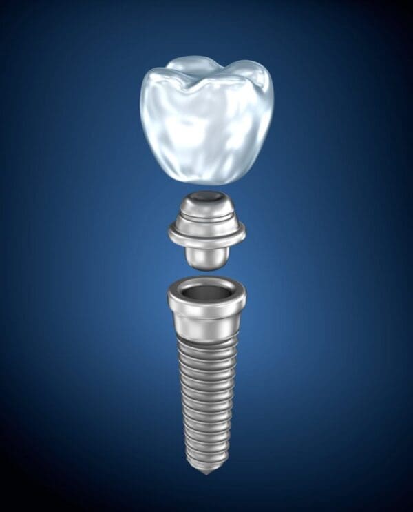 The Components of a Dental Implant | Dentist in Chapel Hill NC